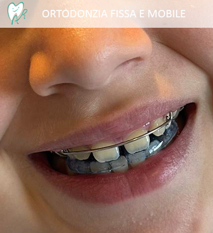 Ortodonzia fissa e mobile con apparecchio per denti